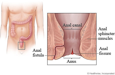 Anal Fissure